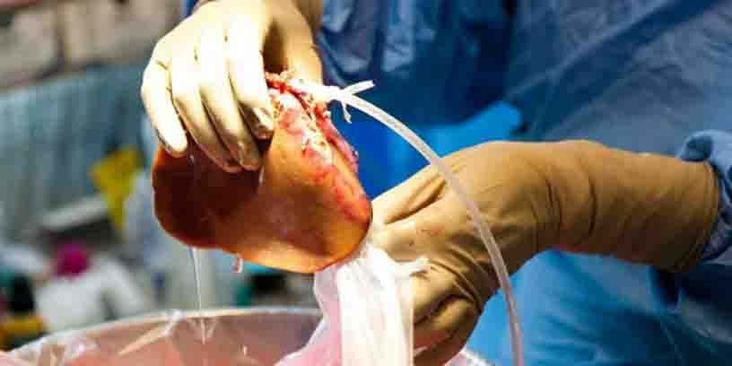 Un chirurgien s'apprête à transplanter un foie